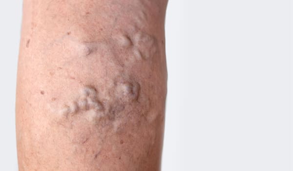 A Tromboflebite Superficial pode desencadear condições mais sérias?